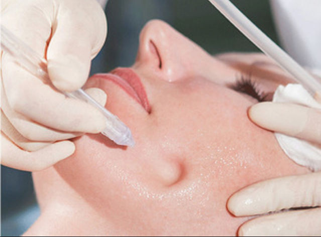 Газожидкостный пилинг Jet Peel! Попробуй новый метод ухода за кожей со скидкой!